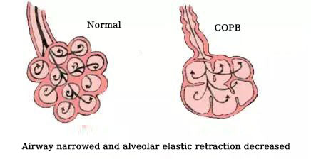 Copd diet | four can eat |four can not eat